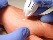 CryClear® krio készülék - 16gr (kb. 60x)