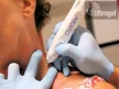CryClear® krio készülék - 16gr (kb. 60x)