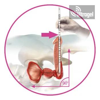EXIME® - Ideiglenes Prosztata Sztent