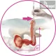 EXIME® - Ideiglenes Prosztata Sztent