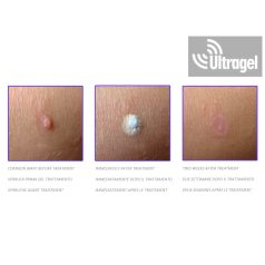 CryoMega® krio készülék - 16gr (kb.30x)