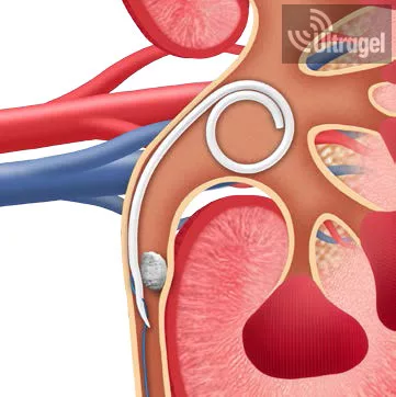 JFil® & MiniJFil® uréter stent