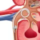 JFil® & MiniJFil® uréter stent