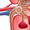 JFil® & MiniJFil® uréter stent