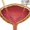 JFil® & MiniJFil® uréter stent