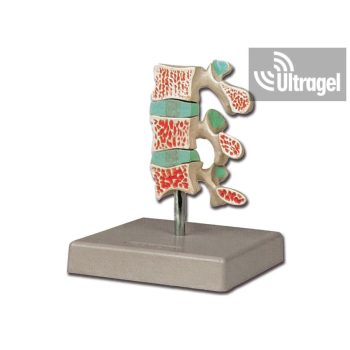 Anatómiai modell CSONTRITKULÁS / OSTEOPORÓZIS